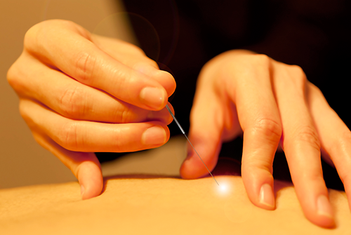 Acupuncture Treatment in NYC